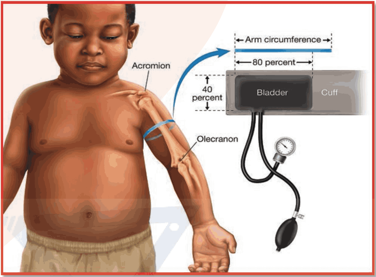 Accurate size of BP cuff for pediatric patients